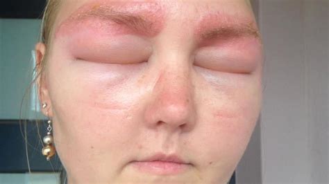 Bride’s Allergic Reaction To Eyebrow Tint The Courier Mail