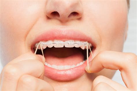 put rubber bands  braces premier orthodontics