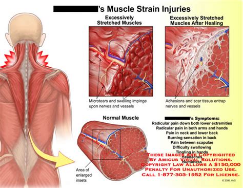 muscle strain injuries