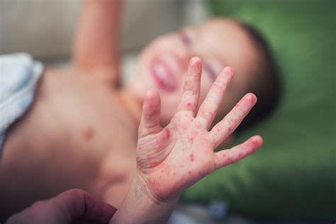 hand foot  mouth disease  symptoms  treatment  science
