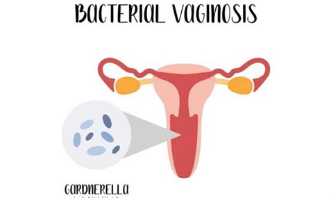 treatments for bacterial vaginosis exhealth