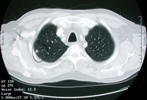 Chest Ct Scan Showing A 1 Cm Right Upper Lobe Nodule Open I
