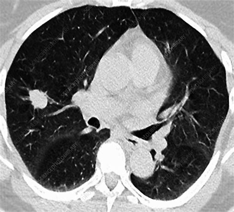 Lung Cancer Ct Scan Stock Image C021 2513 Science
