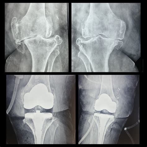 single stage bilateral total knee replacement surgery success knee
