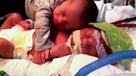 heartbreaking photo of newborn twins hugging goes viral cnn video
