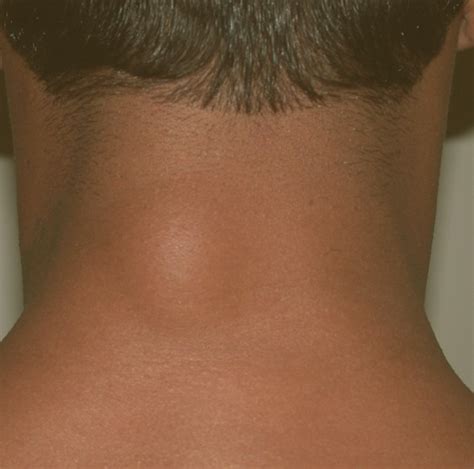 lump    neck pictures   treatment
