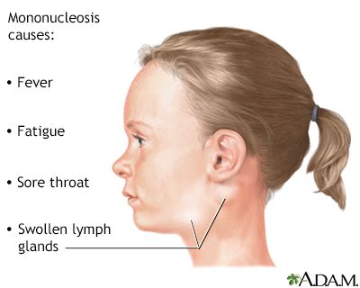 swollen lymph nodes easy  move oxford wasublivis