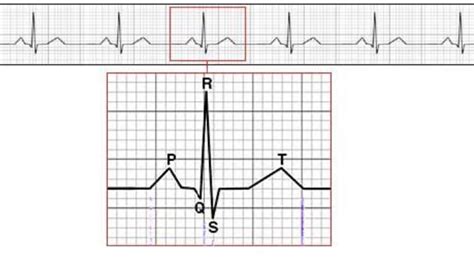 Shows An Example Of A Normal Ecg Trace Download Scientific Diagram