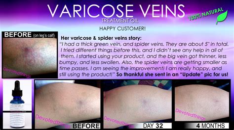 Natural Varicose Vein Treatment And Spider Vein Treatment 2 In 1