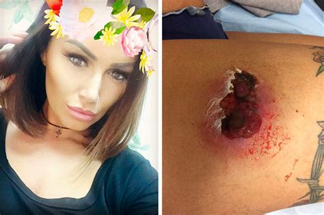 porn star gemma massey left with gaping hole in leg after tanning