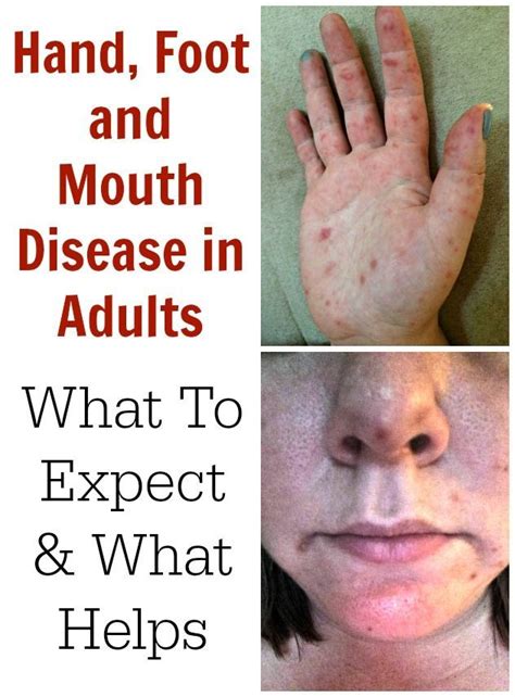 hand foot and mouth disease in adults what to expect remedies