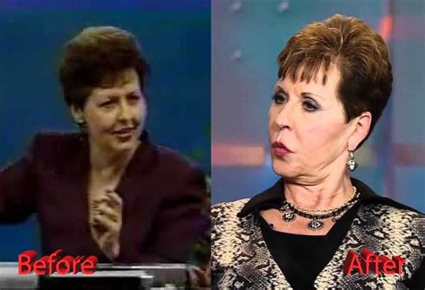 joyce meyer plastic surgery    joyce meyer plastic surgery celebrity plastic