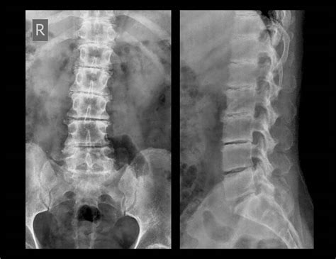 lumbar spine xray abnormal