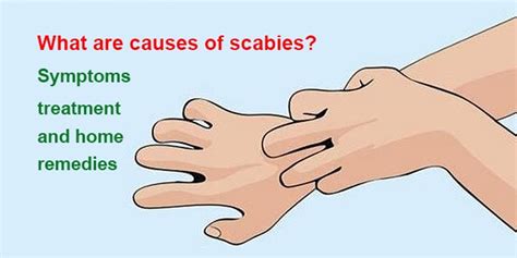 what are causes of scabies symptoms treatment and home remedies