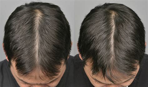 hair restoration satisfying prp results cooley hair center
