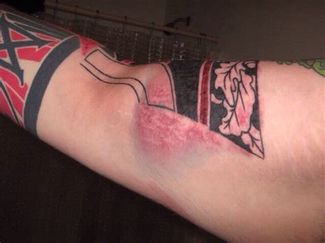 treat tattoo removal infection tattoo removal institute