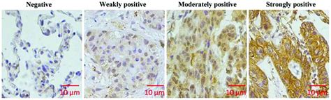 Expression Of Kiaa1456 In Lung Cancer Tissue And Its Effects On