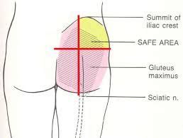 gluteal intramuscular injection sites google search intramuscular injection sites