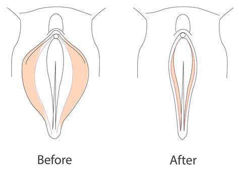 Do Labia Get Bigger With Age – The Home Answer