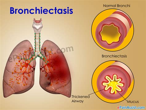 bronchiectasis treatment prevention causes symptoms diagnosis