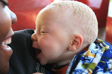 rights  people  albinism  malawi   guranteed  bulawayo