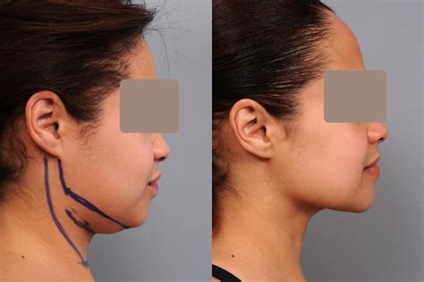 smartlipo neck liposuction  nyc dr sterry