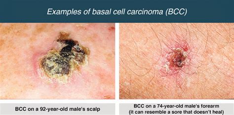 skin cancer types basal cell carcinoma bcc squamous cell carcinoma scc melanoma st louis mo