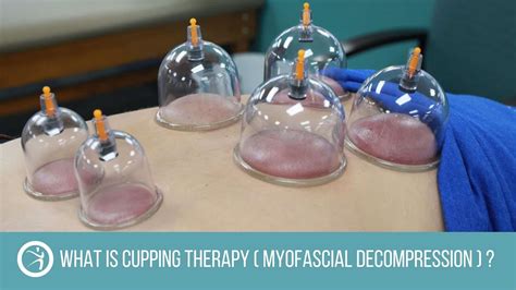 cupping therapy myofascial decompression