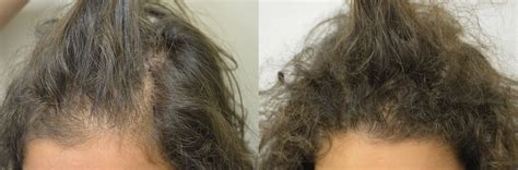 La prima ragione del perché sia le donne sia gli uomini soffrono di diradamento dei capelli è il fattore . Cristina 29 anni: trapianto di capelli donna risultati e foto