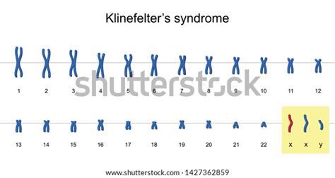 Klinefelters Syndrome Karyotype Nondisjunction Sex Chromosomes 库存矢量图（免