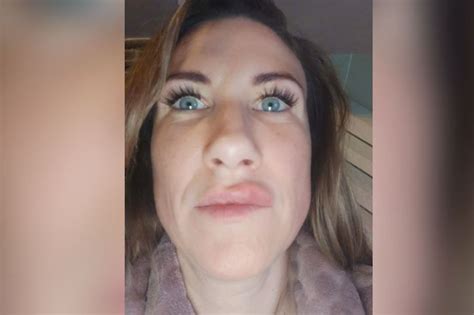 mum s lips exploded five times after dodgy £180 fillers liverpool echo