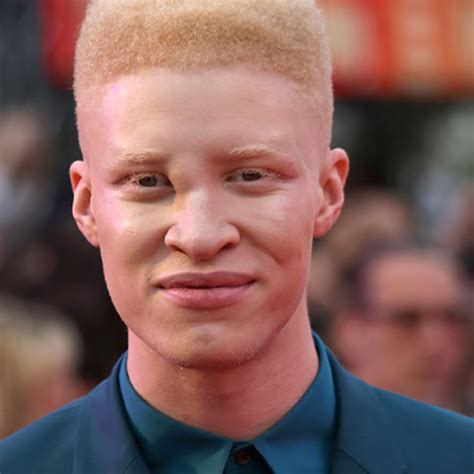 why do some africans with albinism have green eyes the tech interactive