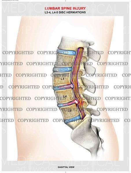 lumbar spine herniations medical art works