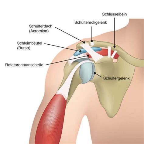 ursache und Übungen beim impingement syndrom in der schulter