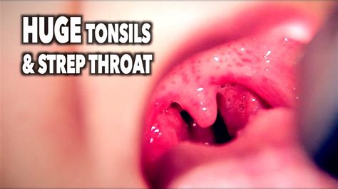 Strep Throat Image Sex Video