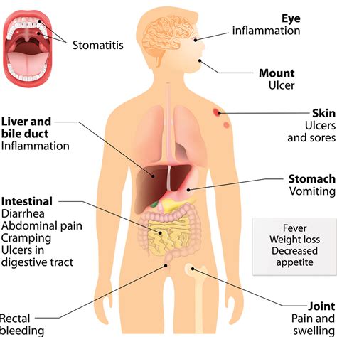 crohns disease alfred gastroeneterology