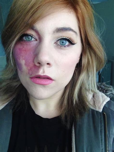 woman with birthmark told she is undateable popsugar beauty