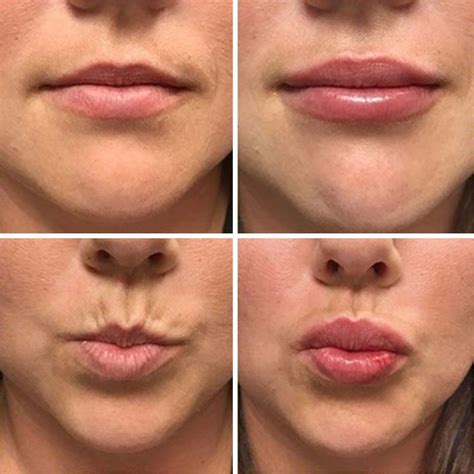 What To Expect During The Lip Fillers Procedure Main Street Cinemas