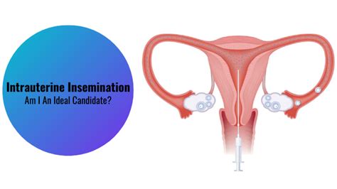 Intrauterine Insemination – Am I An Ideal Candidate Saishree Ivf