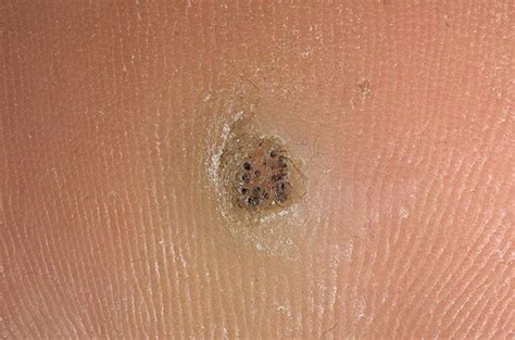 Plantar Wart Pictures 20 Photos And Images