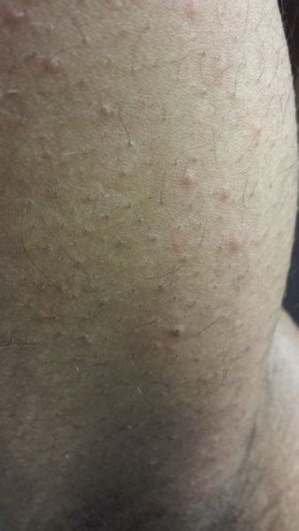 do i have scabies photo doctor answers tips