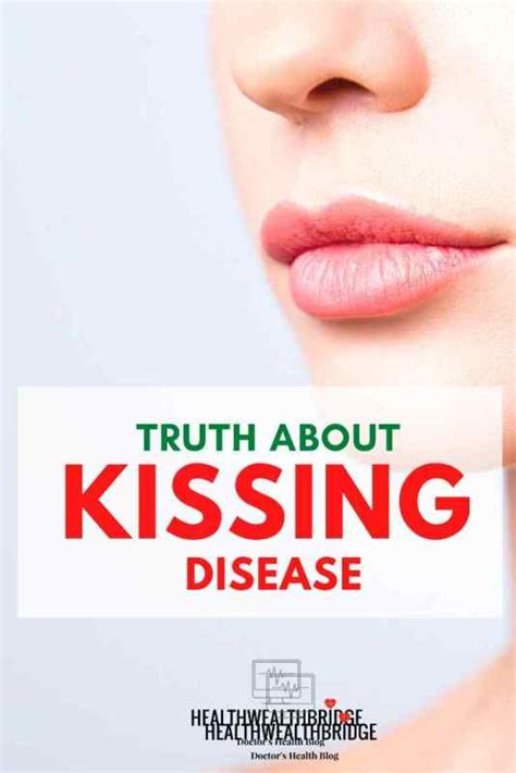 kissing disease  kiss   virus infectious mononucleosis healthwealthbridge