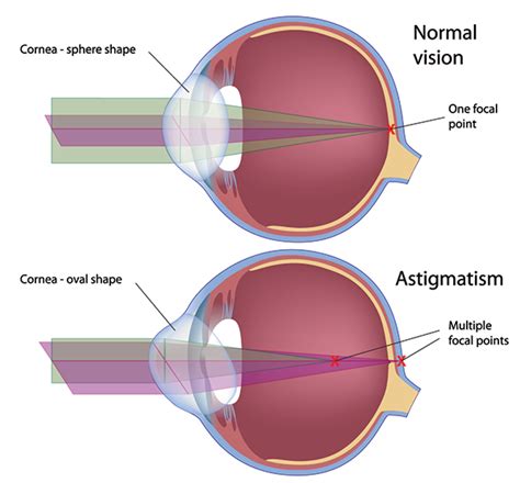 astigmatism in oneida oneida astigmatism astigmatism 13421