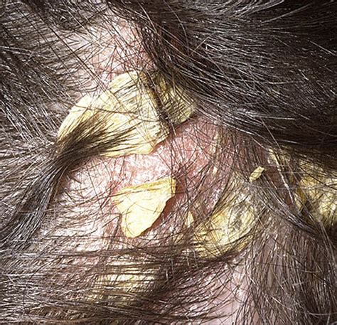 itchy spot  scalp pictures