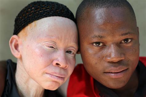 ser una persona  albinismo  es igual en europa  en africa