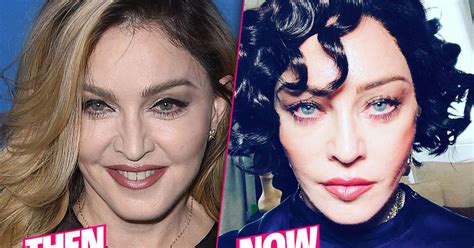 Madonnas Shocking Plastic Surgery Makeover Exposed By Top Docs