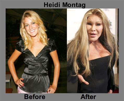 Heidi Before And After Plastic Surgery