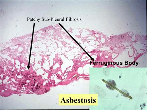 ferruginous bodyasbestosis mesothelioma pleural effusion bronchial