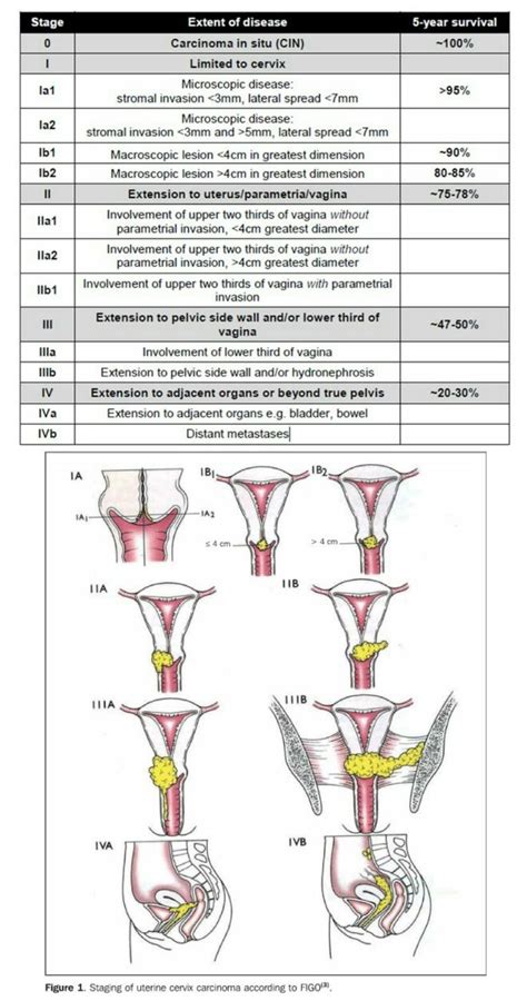 Figo Staging Cervical Cancer Rose Hunter