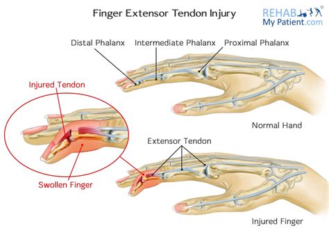 finger extensor tendon injury rehab  patient